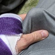 brokenarm